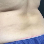 CoolSculpting Before & After Patient #2896