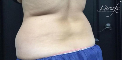 CoolSculpting Before & After Patient #2896