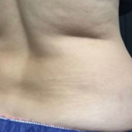 CoolSculpting Before & After Patient #2896