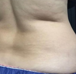 CoolSculpting Before & After Patient #2896