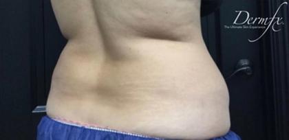 CoolSculpting Before & After Patient #2896