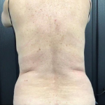 CoolSculpting Before & After Patient #2873