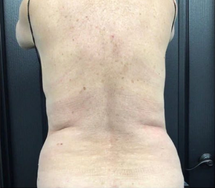 CoolSculpting Before & After Patient #2873