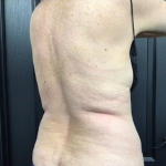 CoolSculpting Before & After Patient #2873