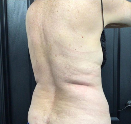 CoolSculpting Before & After Patient #2873