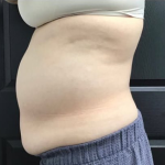 CoolSculpting Before & After Patient #2872