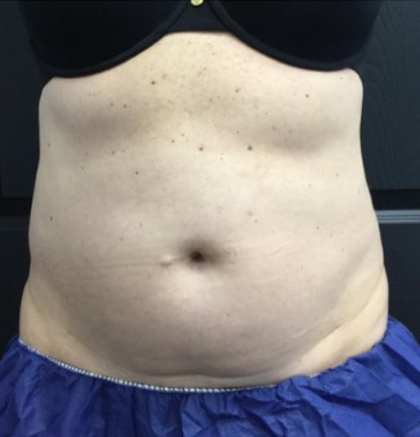 CoolSculpting Before & After Patient #2872