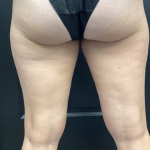 CoolSculpting Before & After Patient #2870
