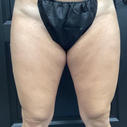 CoolSculpting Before & After Patient #2870