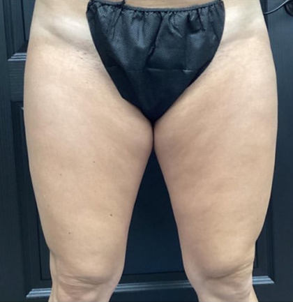 CoolSculpting Before & After Patient #2870