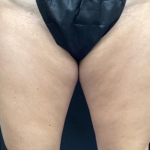 CoolSculpting Before & After Patient #2869