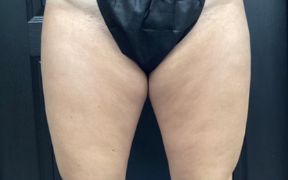 CoolSculpting Before & After Patient #2869