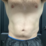 CoolSculpting Before & After Patient #2868