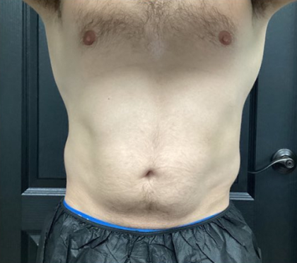 CoolSculpting Before & After Patient #2868
