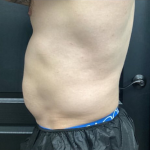 CoolSculpting Before & After Patient #2868