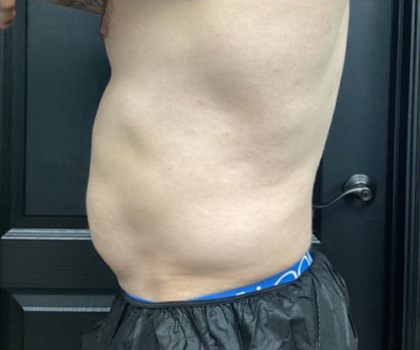 CoolSculpting Before & After Patient #2868