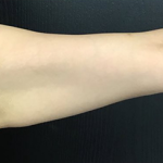 CoolSculpting Before & After Patient #2867