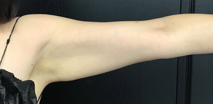 CoolSculpting Before & After Patient #2867