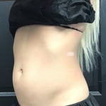 CoolSculpting Before & After Patient #2866