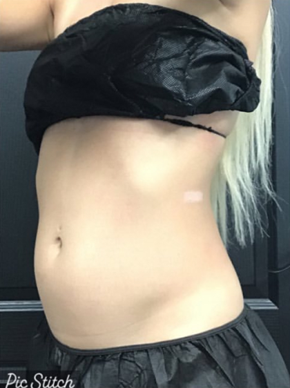 CoolSculpting Before & After Patient #2866