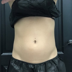 CoolSculpting Before & After Patient #2865