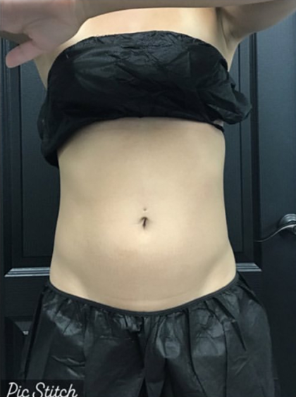 CoolSculpting Before & After Patient #2865