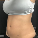 CoolSculpting Before & After Patient #2865