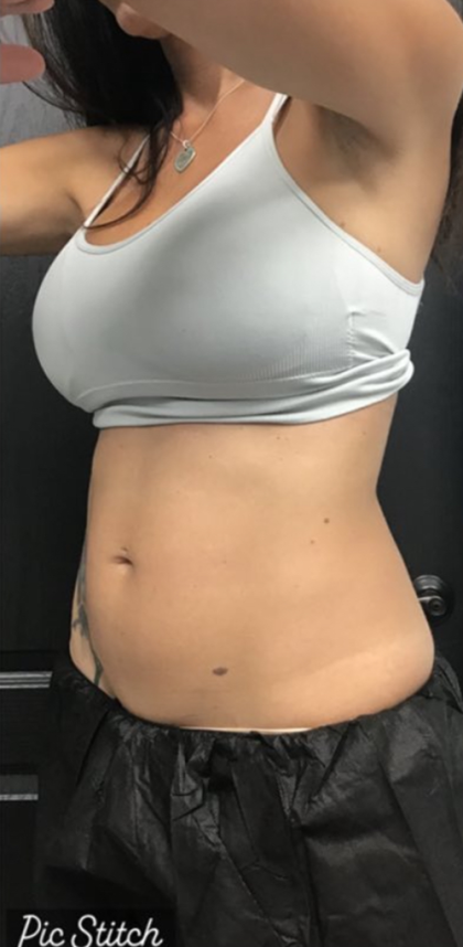 CoolSculpting Before & After Patient #2865