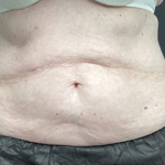 CoolSculpting Before & After Patient #2864