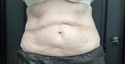 CoolSculpting Before & After Patient #2864