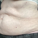 CoolSculpting Before & After Patient #2864