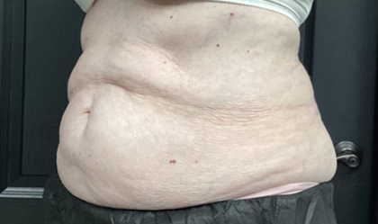 CoolSculpting Before & After Patient #2864