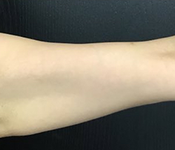 CoolSculpting Before & After Patient #2863