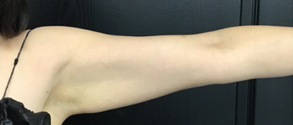 CoolSculpting Before & After Patient #2863