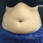 CoolSculpting Before & After Patient #2862