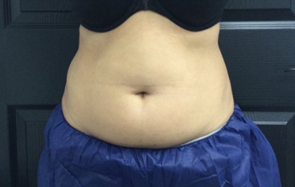 CoolSculpting Before & After Patient #2862