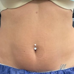 CoolSculpting Before & After Patient #2861