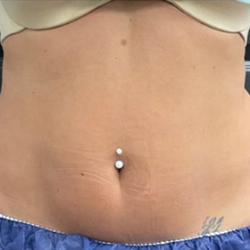 CoolSculpting Before & After Patient #2861