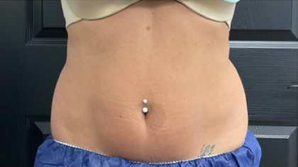 CoolSculpting Before & After Patient #2861