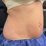 CoolSculpting Before & After Patient #2861