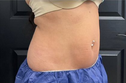 CoolSculpting Before & After Patient #2861