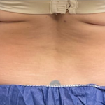 CoolSculpting Before & After Patient #2861