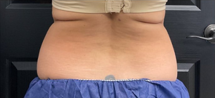 CoolSculpting Before & After Patient #2861