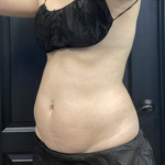 CoolSculpting Before & After Patient #2860