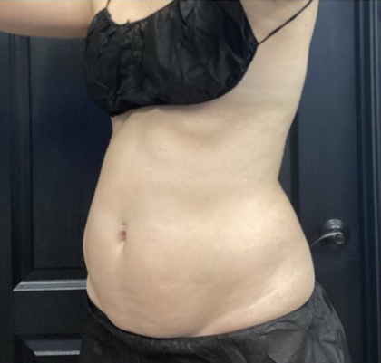CoolSculpting Before & After Patient #2860