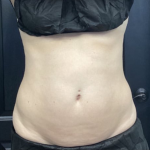 CoolSculpting Before & After Patient #2860