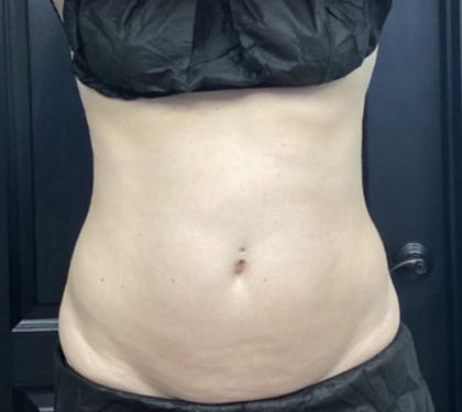 CoolSculpting Before & After Patient #2860