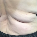 CoolSculpting Before & After Patient #2857