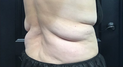 CoolSculpting Before & After Patient #2857