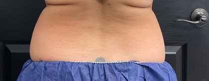 CoolSculpting Before & After Patient #2723